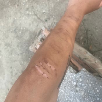 Deva Güzellik Ve Lazer Merkezi Lazer Epilasyonu Yanağı