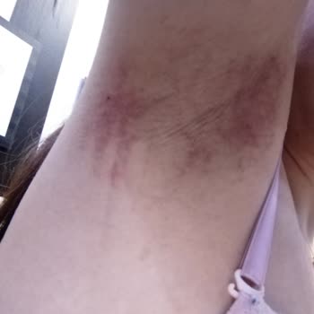 Tereson Verecek Olasıca Sprey