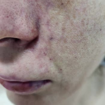 Prof. Dr. Ahmet Demir Yanlış Dolgu Uygulaması