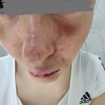 Prof. Dr. Ahmet Demir Yanlış Dolgu Uygulaması