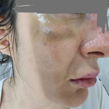 Prof. Dr. Ahmet Demir Yanlış Dolgu Uygulaması