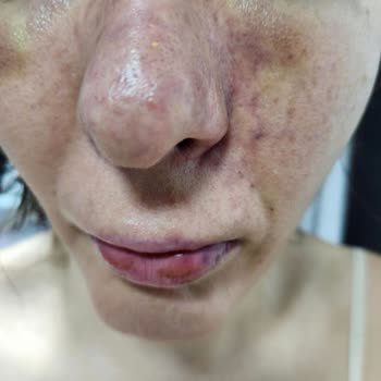 Prof. Dr. Ahmet Demir Yanlış Dolgu Uygulaması