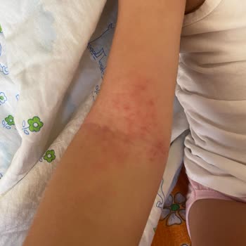 Siveno Güneş Kremi Alerji Yaptı