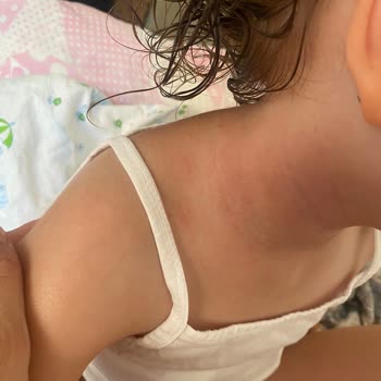 Siveno Güneş Kremi Alerji Yaptı