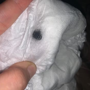Sleepy Bebek Bezinin İçinden Siyah Madde Çıktı