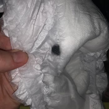 Sleepy Bebek Bezinin İçinden Siyah Madde Çıktı