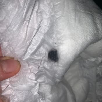 Sleepy Bebek Bezinin İçinden Siyah Madde Çıktı