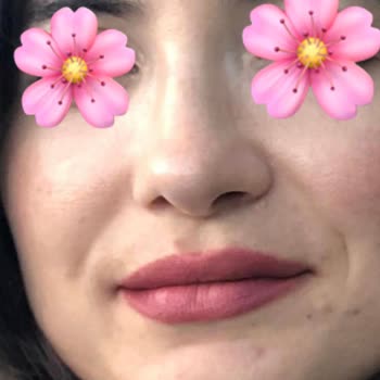 Dr. Eyüp Bozkurt Burun Ameliyatı Sonrası Burnum Daha Kötü Oldu!