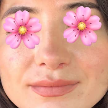 Dr. Eyüp Bozkurt Burun Ameliyatı Sonrası Burnum Daha Kötü Oldu!