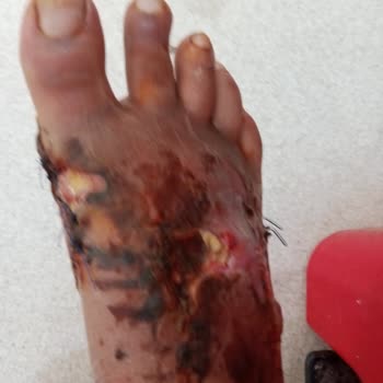 Sağlık Bakanlığı Kirik Ayağa Yüzde 0 Oran Veren Samsun Egitim Araştırma Hastanesi Heyet