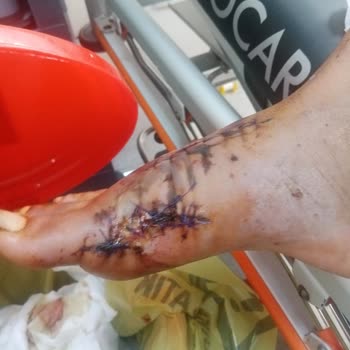 Sağlık Bakanlığı Kirik Ayağa Yüzde 0 Oran Veren Samsun Egitim Araştırma Hastanesi Heyet