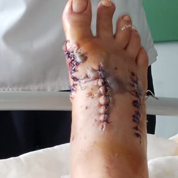 Sağlık Bakanlığı Kirik Ayağa Yüzde 0 Oran Veren Samsun Egitim Araştırma Hastanesi Heyet