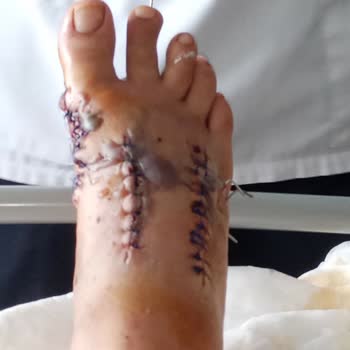 Sağlık Bakanlığı Kirik Ayağa Yüzde 0 Oran Veren Samsun Egitim Araştırma Hastanesi Heyet