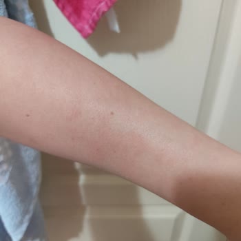 Duru Duş Jeli Her Yerimi Kabarttı Kaşıntı Ve Acıdan Duramıyorum