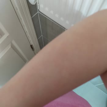 Duru Duş Jeli Her Yerimi Kabarttı Kaşıntı Ve Acıdan Duramıyorum