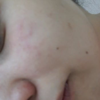 Gratis Yüzüme Alerji Yaptı