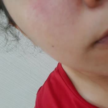 Gratis Yüzüme Alerji Yaptı