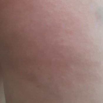 Darphin Anti-Cellulite Contouring Gel Kullanımı Sonucu Oluşan Kızarıklık Ve Kaşıntı