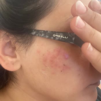 Gratis Bee Beauty Maske Sivilce Yaptı