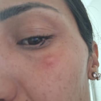 Nyx Concealer Serum Alerji Yaptı