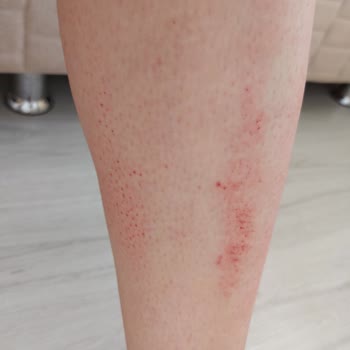 Tüy Silgisi (Kristal Epilatör) Her Yerim Yara Oldu