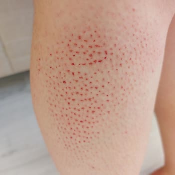 Tüy Silgisi (Kristal Epilatör) Her Yerim Yara Oldu