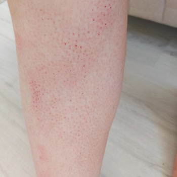 Tüy Silgisi (Kristal Epilatör) Her Yerim Yara Oldu