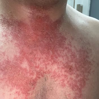 Bioder Vücudumu Tahriş Etti Yaralar Oluştu