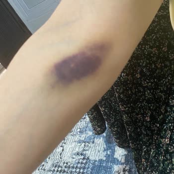 Bursa Yüksek İhtisas Eğitim ve Araştırma Hastanesi Damar Patlaması Sonucu