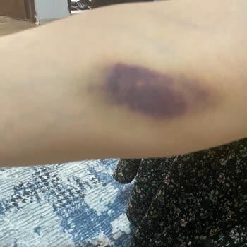 Bursa Yüksek İhtisas Eğitim ve Araştırma Hastanesi Damar Patlaması Sonucu