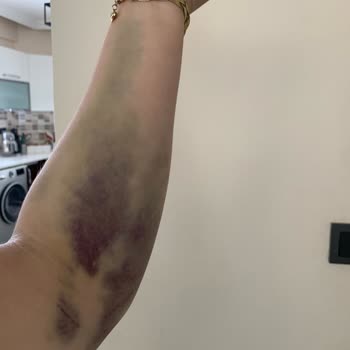 Özel Didim Batı Tıp Merkezi Kolumda Kan Verdikten Sonra Ciddi Derecede Morarma Var!