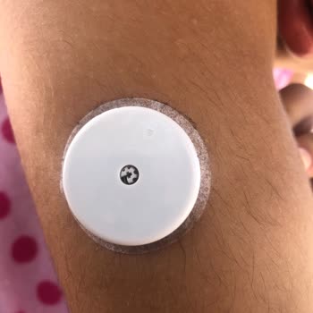 Freestyle Libre Sensör Şeker Ölçüm Cihazının Doğru Şekilde Çalışmaması
