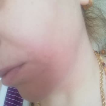 Dr. Öz Klinik Alerji Yapan Krem