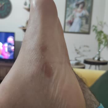 Crocs Terlik Yanlardan Ayağımı Yaralıyor