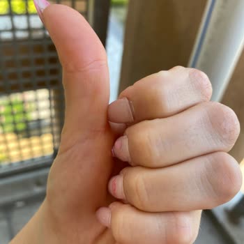 Aymira Koçaklı Yaşam Merkezi Aymira Koçaklı Protez Tırnak Mağduriyeti