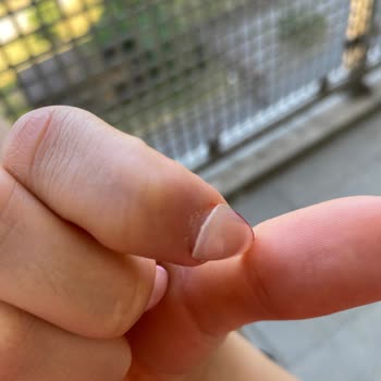 Aymira Koçaklı Yaşam Merkezi Aymira Koçaklı Protez Tırnak Mağduriyeti