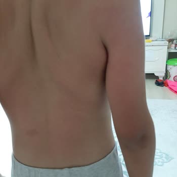 Migros'taki Sebamed Güneş Kremi Yanık Yaptı