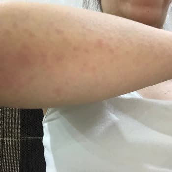 A101 Mağazasından Alınan Carnus Shower Gel Ürününe Alerji Tepkisi