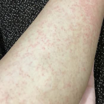 A101 Mağazasından Alınan Carnus Shower Gel Ürününe Alerji Tepkisi