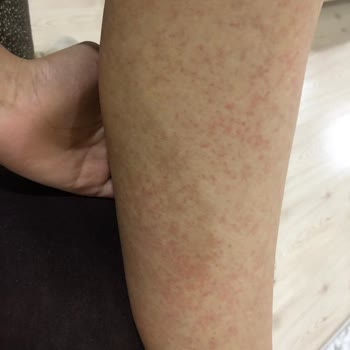 A101 Mağazasından Aldığım Carnus Shower Gel Ürününe Alerji Reaksiyonu