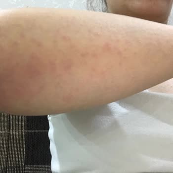 A101 Mağazasından Aldığım Carnus Shower Gel Ürününe Alerji Reaksiyonu