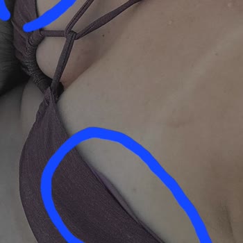 Penti Ürünün Vücudu Alerji Yapıp Yara Bere İçinde Bırakması