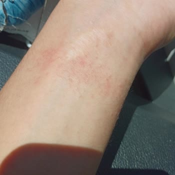 Xiaomi Bileğimde İsilik Çıkarttı