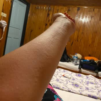 Eda Taşpınar Bronzlaştırıcı Kaşıntı Kabarıklık Yaptı