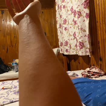 Eda Taşpınar Bronzlaştırıcı Kaşıntı Kabarıklık Yaptı