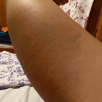 Eda Taşpınar Bronzlaştırıcı Kaşıntı Kabarıklık Yaptı