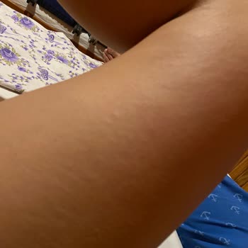 Eda Taşpınar Bronzlaştırıcı Kaşıntı Kabarıklık Yaptı