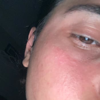 Yves Rocher Pure Algue Yüz Yıkama Jeli Ve Toniği Kullanırken Kızarıklık Ve Yanma Hissi Oluştu