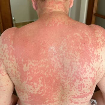 Abdi İbrahim Factive İlacının Alerjik Olması