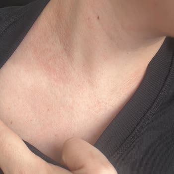 Atelier Duygunun Antialerjik Diye Sattığı Ürünleri Alerji Yapıyor